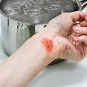 Common Causes Of Burn Injuries In New Jersey Kronberg Law Firm